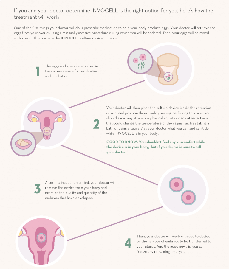 IVC - INVOCELL - Fertility Treatment Option - ORM Fertility