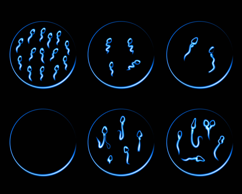 Graphic showing 6 potential findings of a sperm analysis ranging from low sperm count to poor sperm motility.